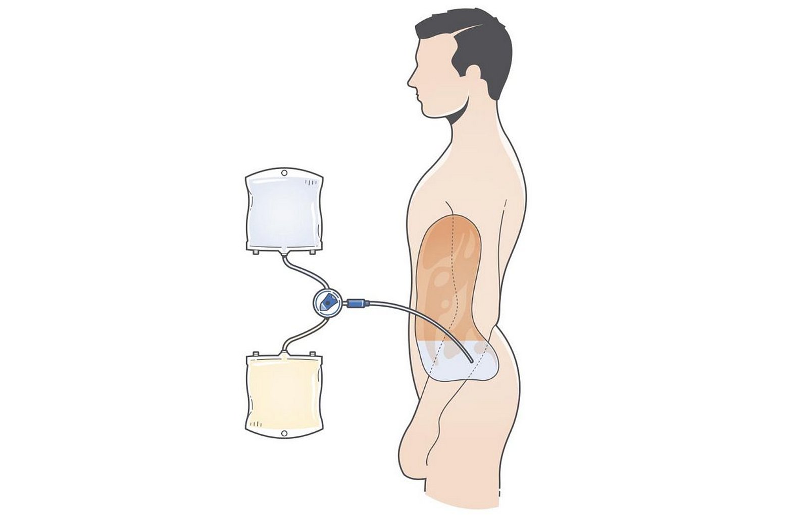 Raffigurazione del trattamento di dialisi peritoneale